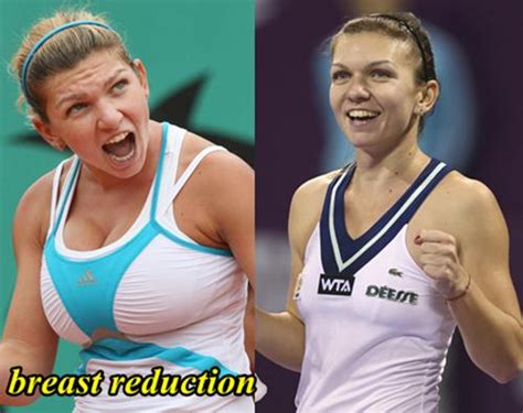 simona halep tits|Simona Halep Before and After Breast Reduction Surgery